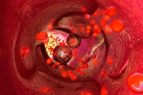 کارآزمایی درمان سرطان مقاوم به درمان با سلول ایمنی غیرخویشاوندی