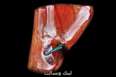 اسكنر اشعه ایكس رنگی سه بعدی از رگ ها عكس می گیرد